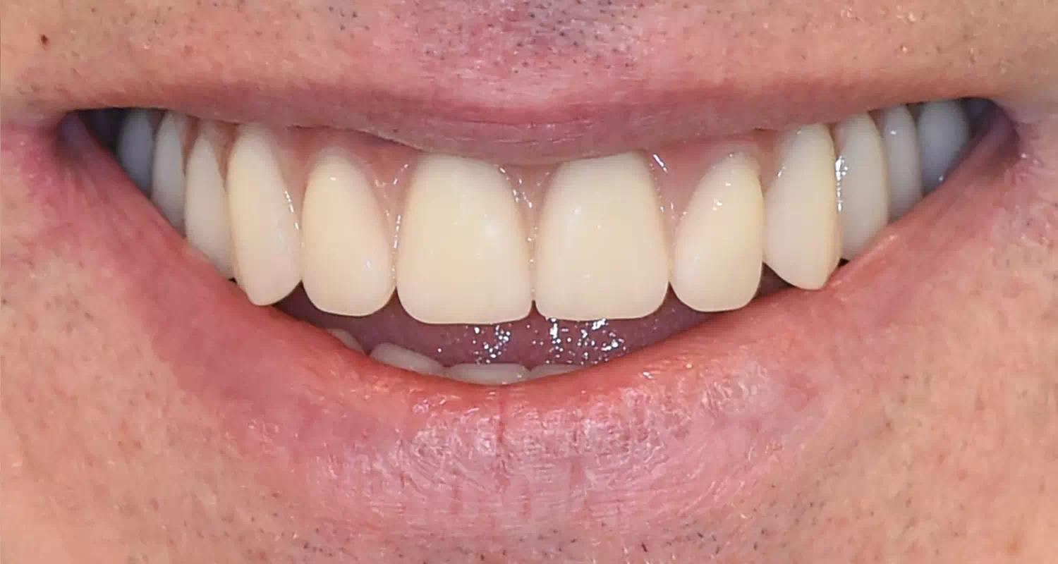Cas implants dentaires all-on-4 après traitement