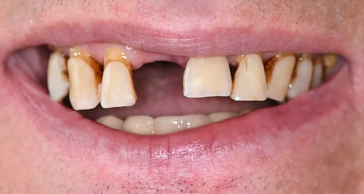 Cas implants dentaires all-on-4 avant traitement