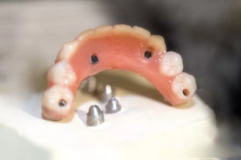 Prothèse dentaire partielle
