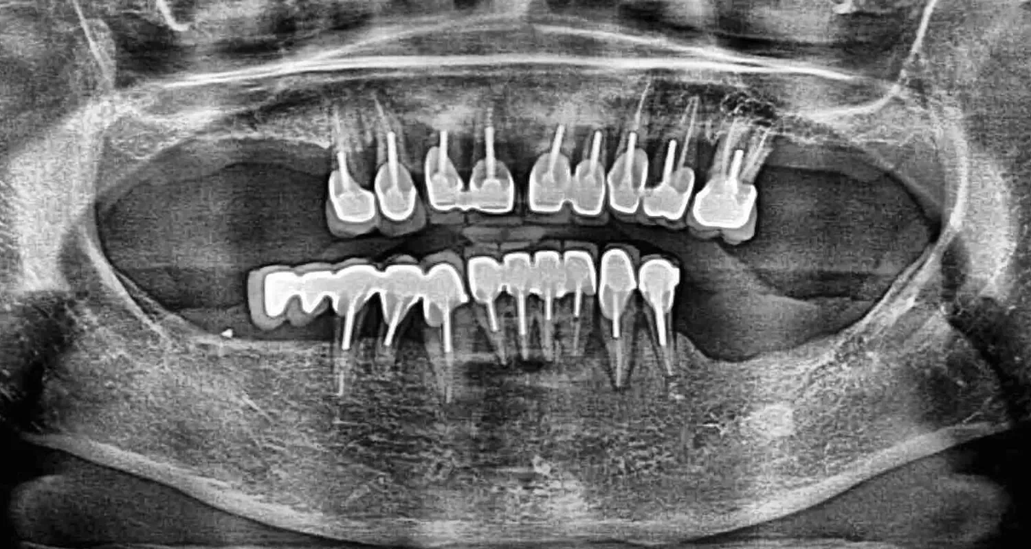 Radio dents cas all-on-4 avant