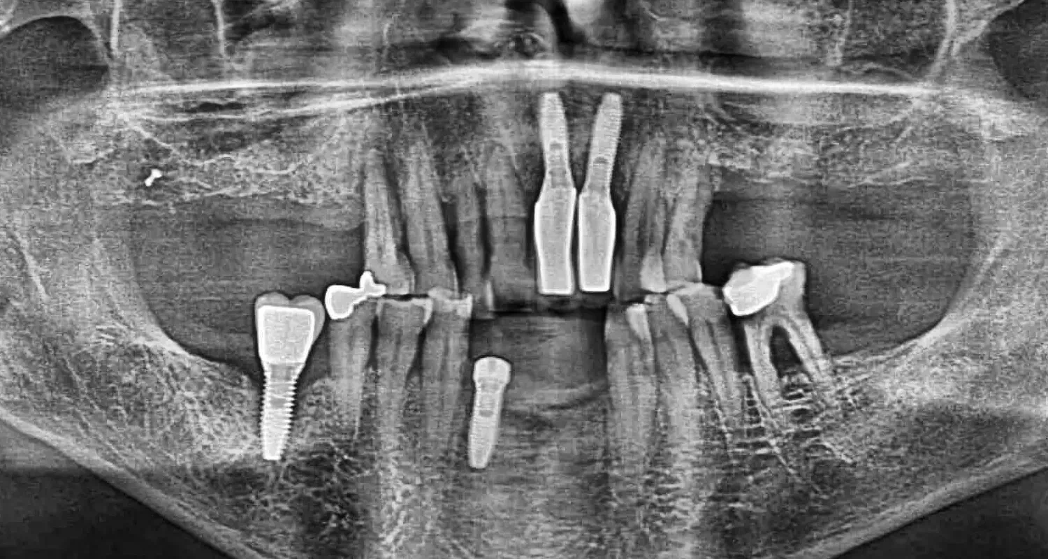 Radio dents cas all-on-6 avant