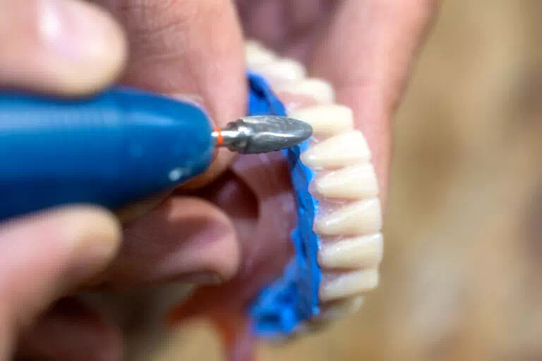 Fabrication prothese dentaire résine