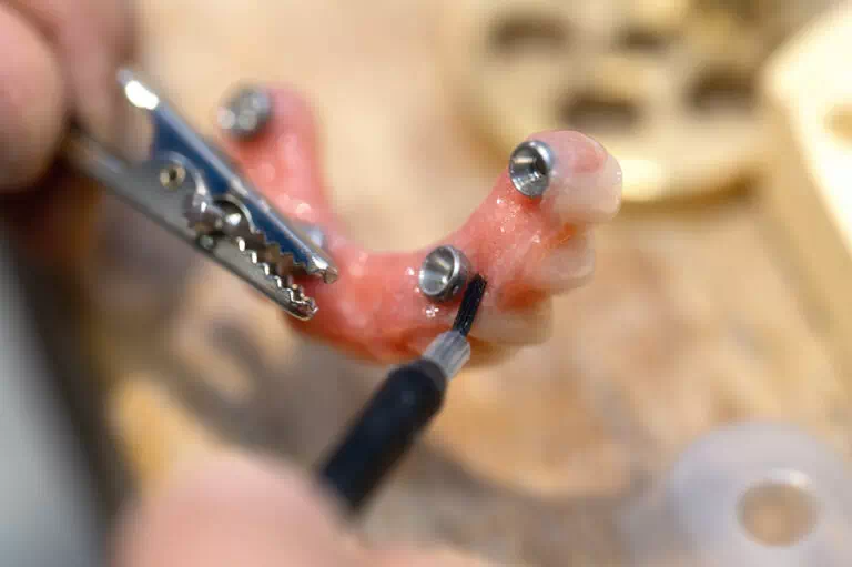 Vernissage prothèse implants