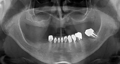 Radio dents avant imlpants zygomatiques